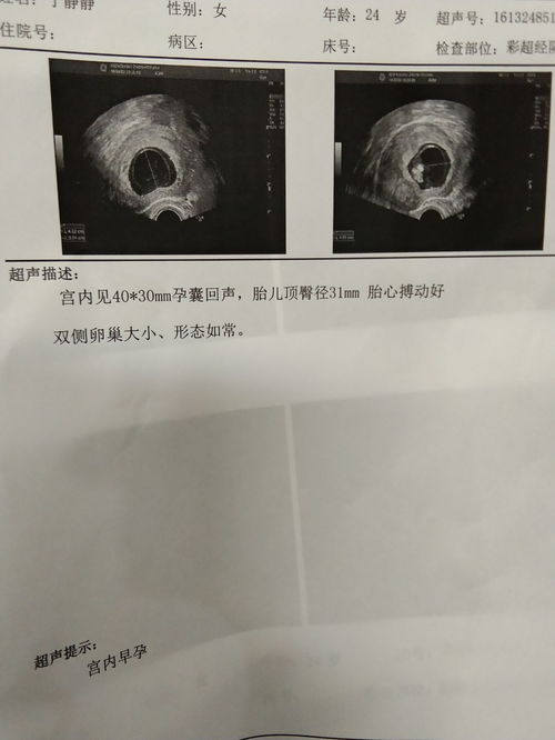 怀孕35天的孕囊大小