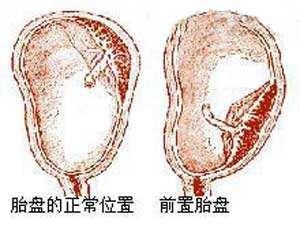 前置胎盘剖腹产会大出血吗?