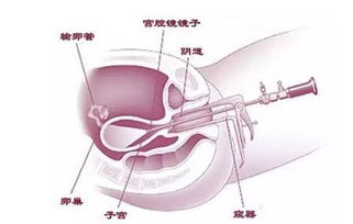 做宫腔镜检查后可以同房吗