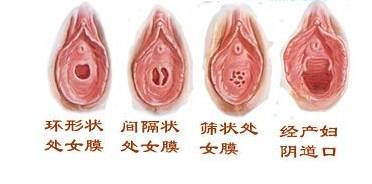 巴氏腺囊肿会影响月经量吗