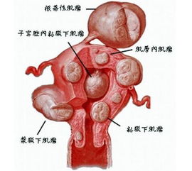 巴氏腺囊肿会影响月经量吗