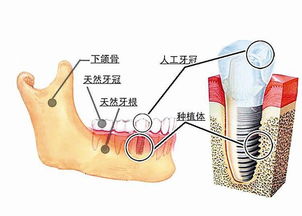 假牙怎样长期保存