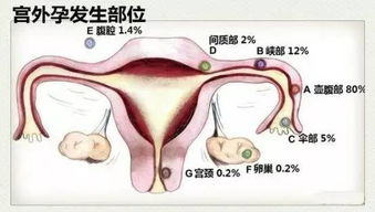 女子宫外孕严重吗怎么治疗