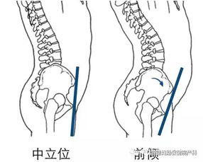 骨盆前倾对受孕怀孕有影响吗