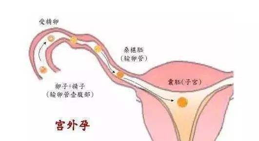 输卵管妊娠是什么意思?