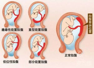 胎盘后壁低置会怎么样