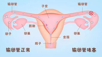 右侧输卵管通而不畅会宫外孕吗