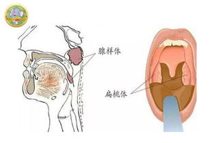 孕中期鼻炎鼻塞对胎儿影响有哪些症状