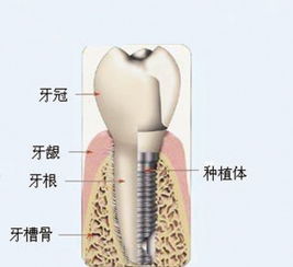 种植牙从开始到结束需要多长时间