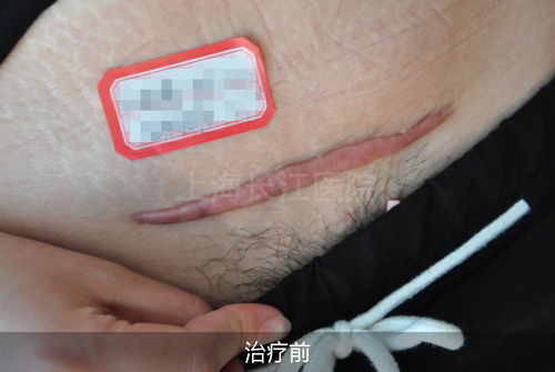 剖腹产疤痕完全消除