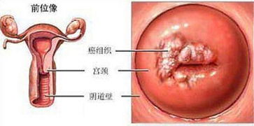 慢性宫颈炎会癌变吗可能性多大