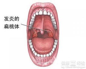 慢性咽炎加慢性支气管炎长达两年该吃什么西药