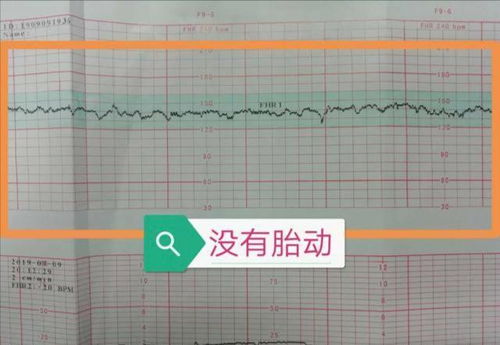 怀孕32+5天听胎心时在170左右正常吗？