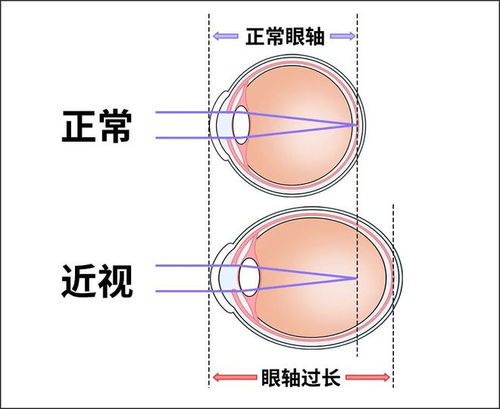 近视度数为什么每年都会加深的