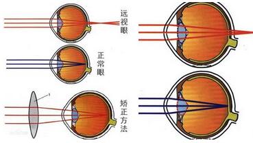 近视度数为什么每年都会加深的