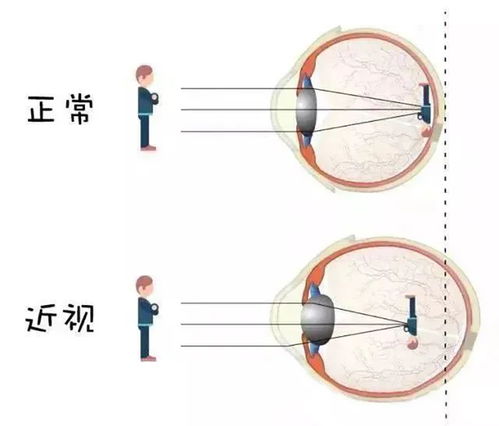 近视度数为什么每年都会加深的