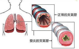 怀孕快八个月得支气管炎