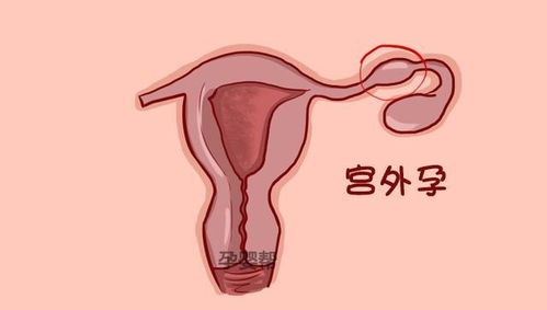 卵泡破裂出血会影响怀孕吗