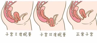 老年阴道炎吃什么药