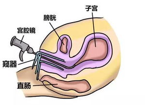 宫腔镜适用于哪些疾病检查