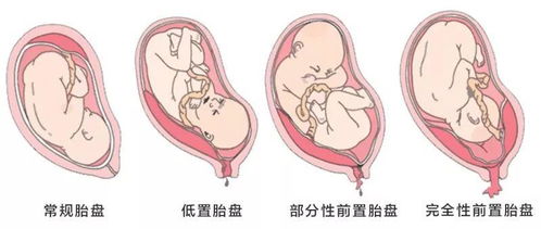 羊水指数多少算正常？