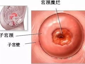 宫颈癌的临床特点