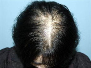 治疗脂溢性脱发要服用多久的维生素B6