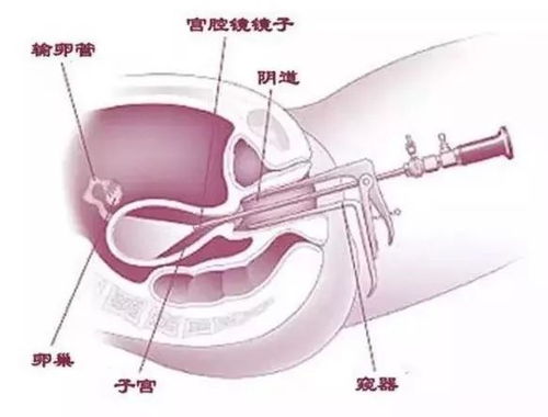 宫腔镜检查完能马上上班吗