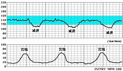 胎监监测结果里的变异幅度是什么意思