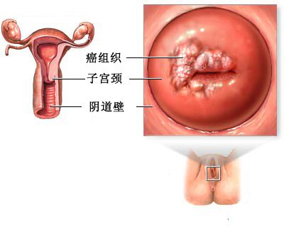 宫颈糜烂会导致不孕吗?