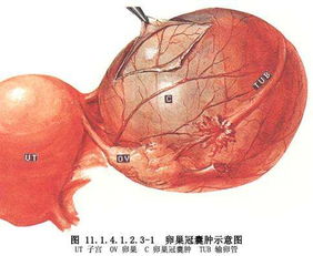 得了卵巢囊肿该怎么办