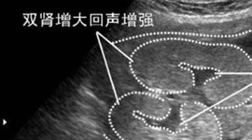 孕24周四维彩超上双肾未见分离是什么意思