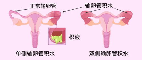 取卵一般几个最好 新闻