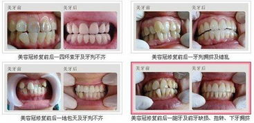 正常牙齿受的磨损需要治疗吗