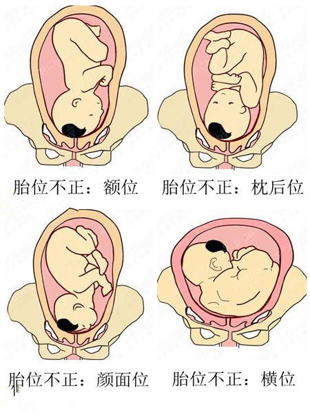 胎位低就是指的下怀吗图片