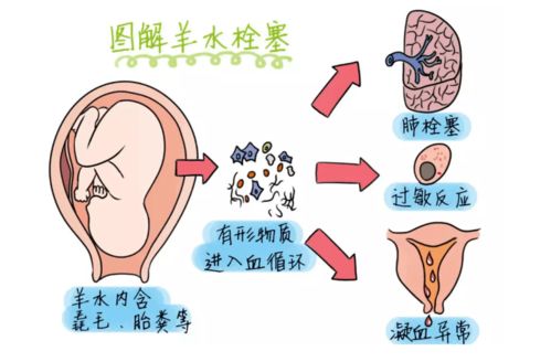 胎心率减速变化的常见类型及各种类型的特点是什么？