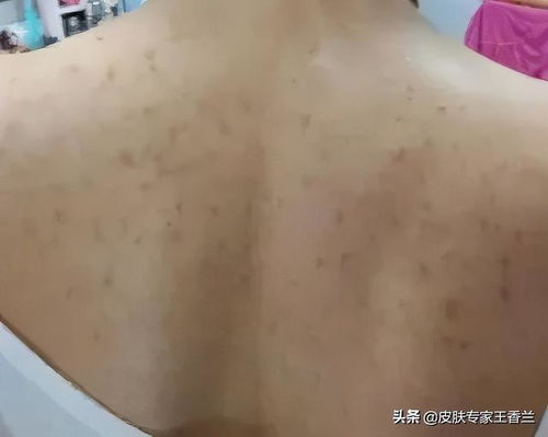 背上长痘痘是毛囊炎吗