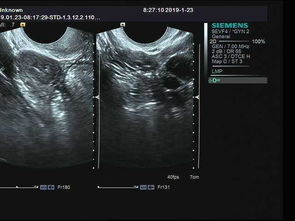 卵巢扭转彩超能看出来吗
