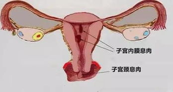 造成宫角妊娠的原因有哪些