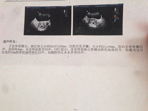 B超显示:孕囊4.9cm*1.8cm,卵黄囊0.55cm，胚芽1.6cm，见原始心管搏动，孕囊外见