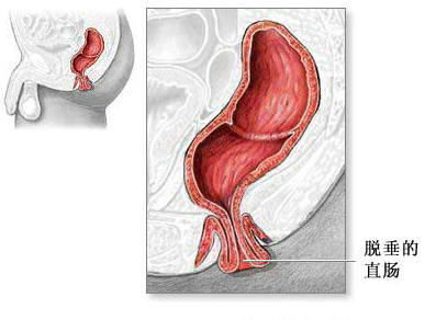 直肠粘膜内脱垂症状