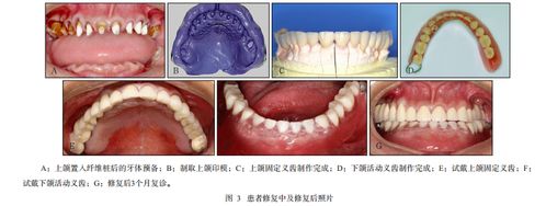 30多岁就带活动义齿心情很压抑