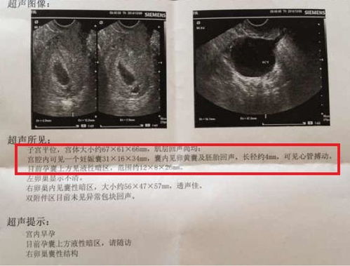 怀孕五十五天孕囊25mmx14mm椭圆形是男孩还是女孩