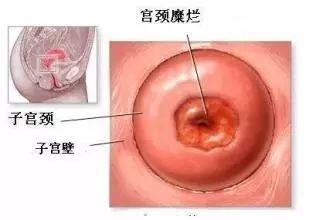 公务员体检宫颈糜烂有影响吗