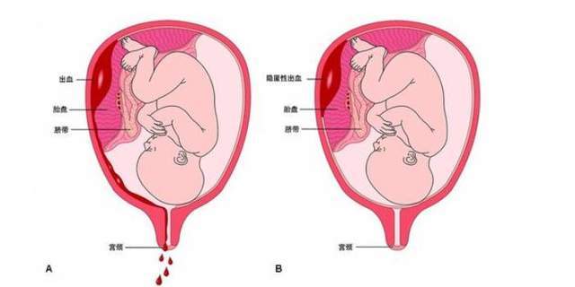 胎盘早剥孕妇有感觉吗时候开始