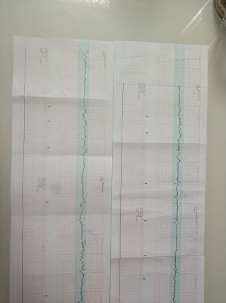 35周+ 彩超脐血流数值高于正常值，胎心监护不过关怎么办啊？