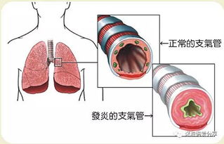 宝宝支气管炎怎么办