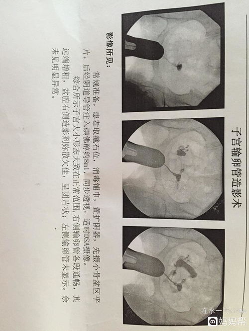 输卵管远端粘连算严重的吗