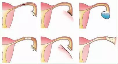 输卵管积液有什么影响吗