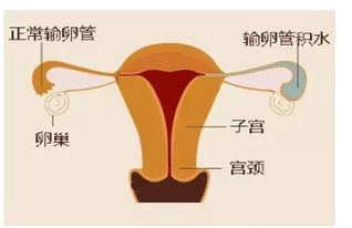 输卵管积液有什么影响吗